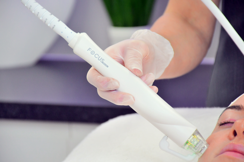 Focus Dual Radiofrequency Microneedling (RFM) Treatment