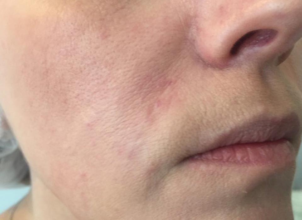 Dermal Filler After
