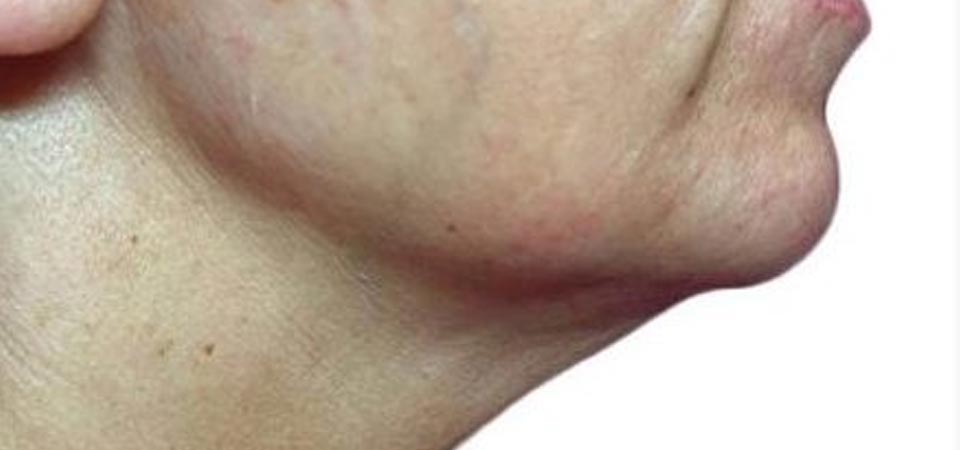 Strawberry Lift After