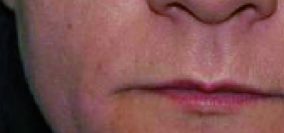 Viscoderm After