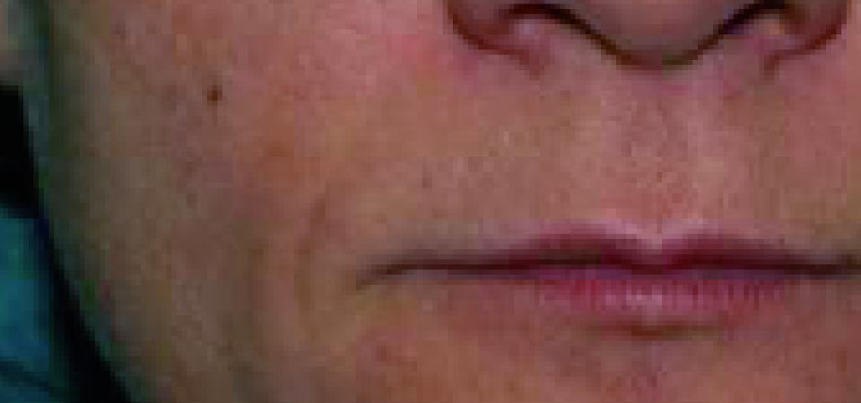 Viscoderm Before