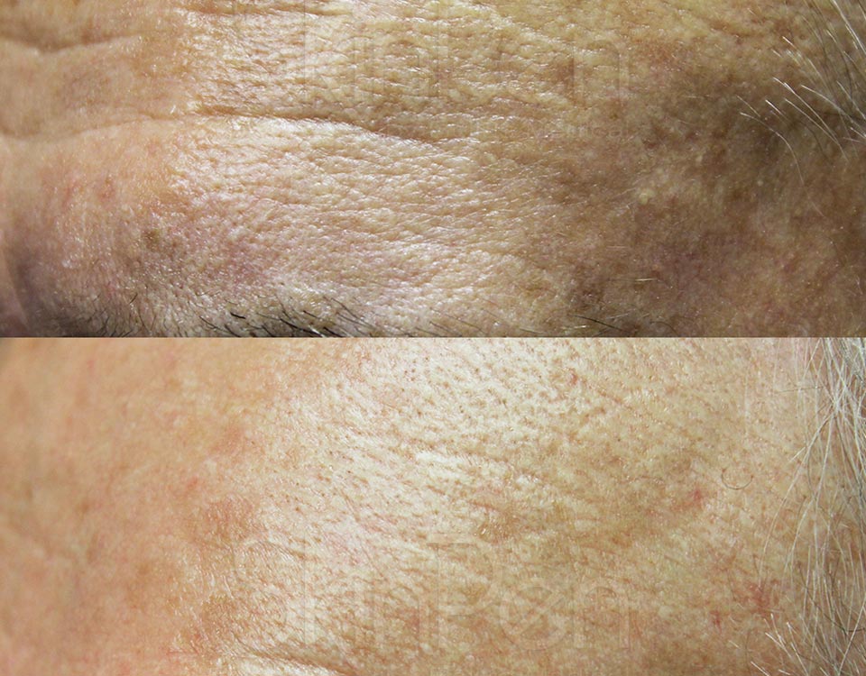 Wrinkle Reduction