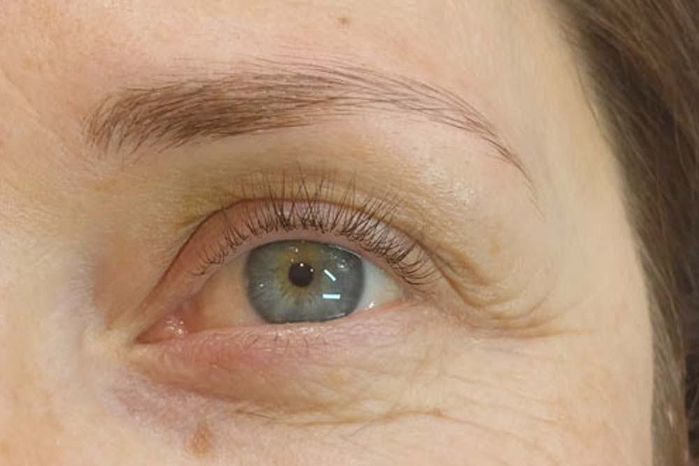 brow treatment after