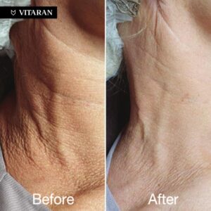before and after Polynucleotide Skin Booster Treatment