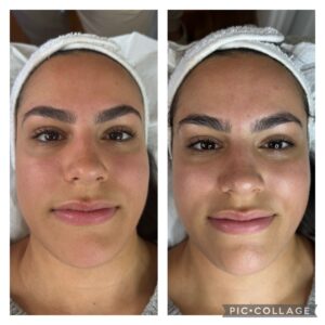 SMARTHydro-GEN facial before & after