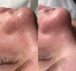 SMARTHydro-GEN Before & After