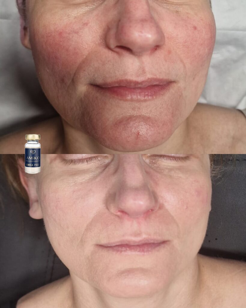 Amiko peel before & After