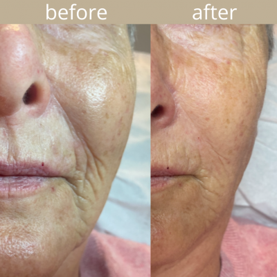 Seventy Hyal Before & After